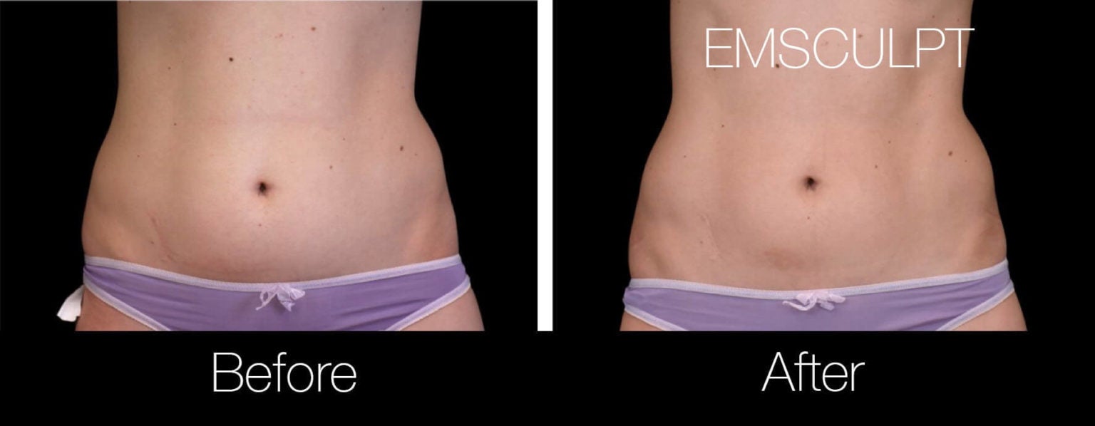 Body Contouring-1