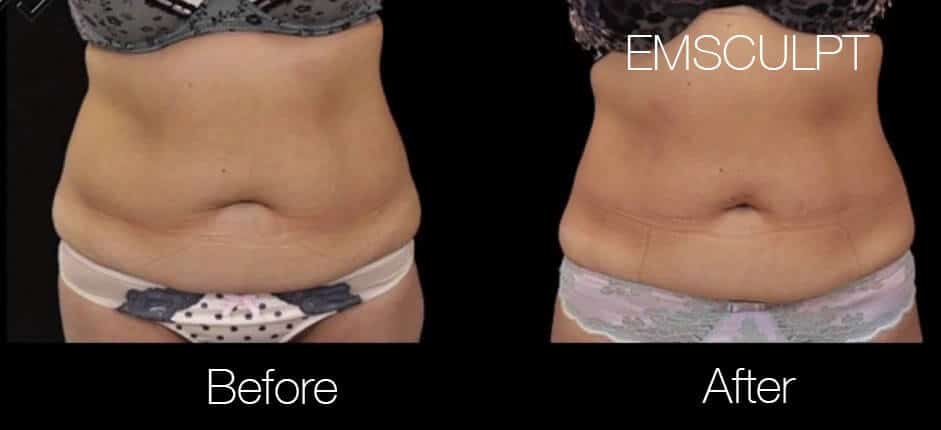 Body Contouring-2