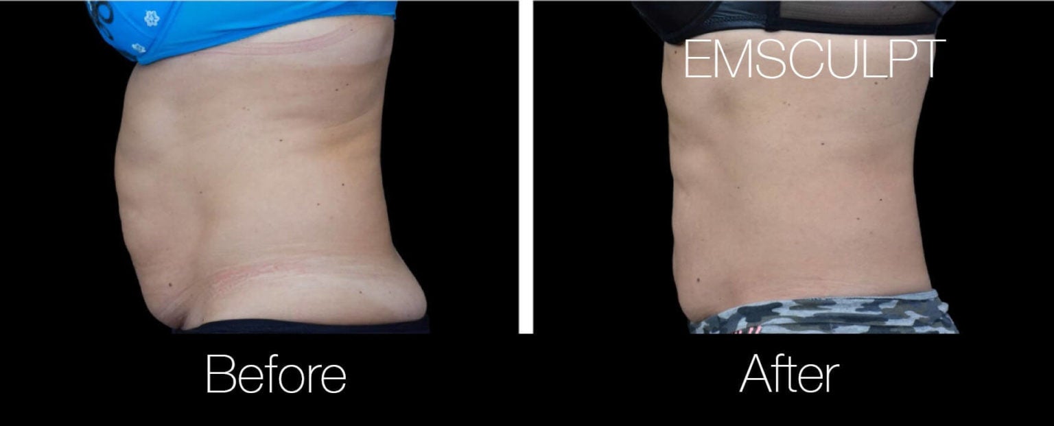 Body Contouring-3