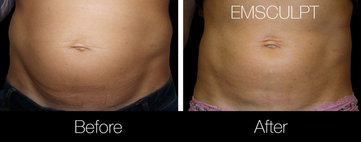 Body Contouring-4