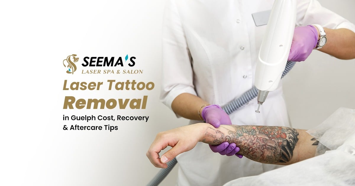 tatto removal in guelph