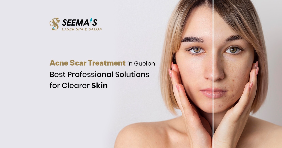Acne Scar Treatment in Guelph