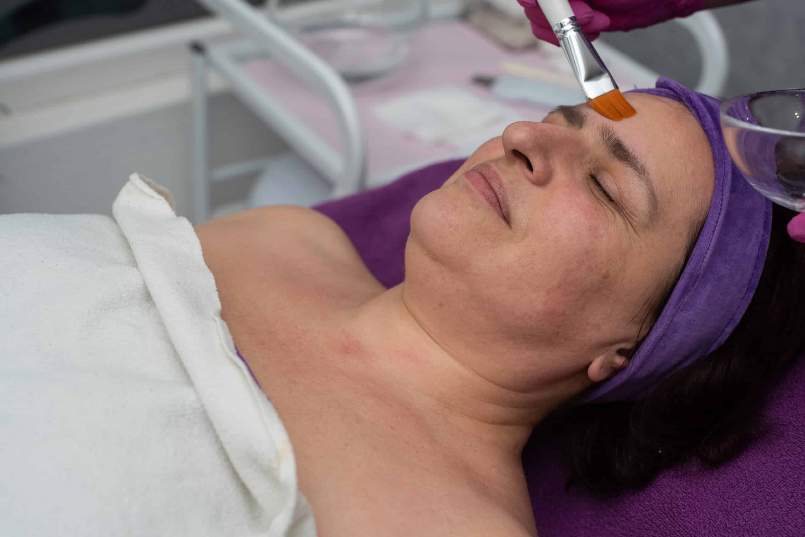 Dermamelan & Melasma Treatment near Guelph