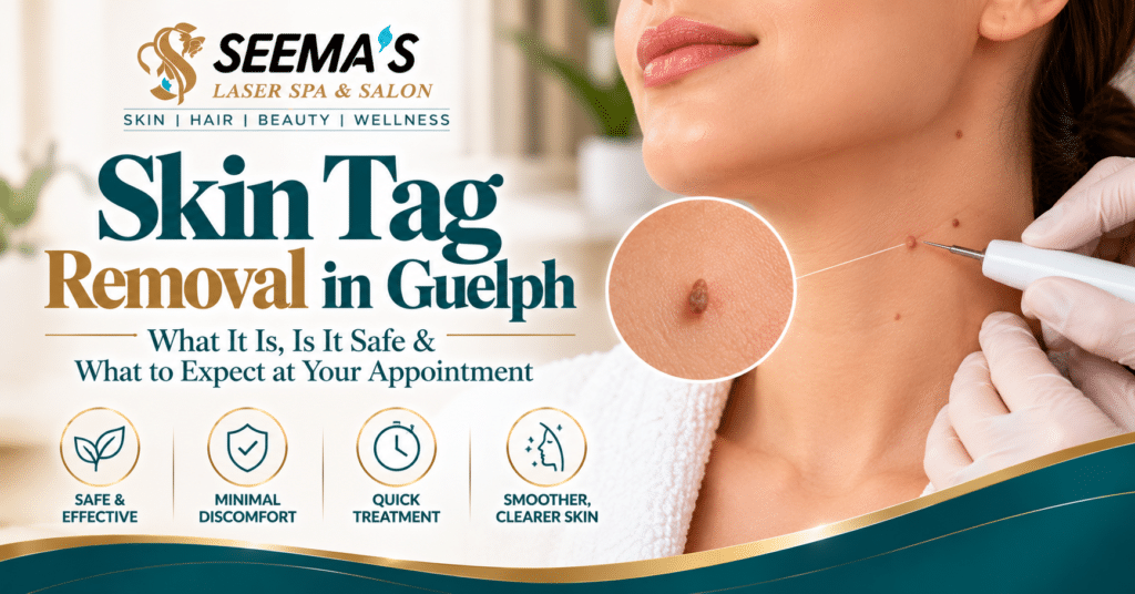 skin tag removal in Guelph